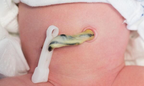 کلمپ بند ناف برند بکر - Image 3